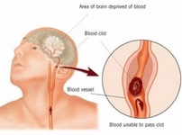 Beyinde Kan Pıhtısının Tedavisi