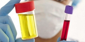 İdrarda Kan Pıhtısı Nedenleri