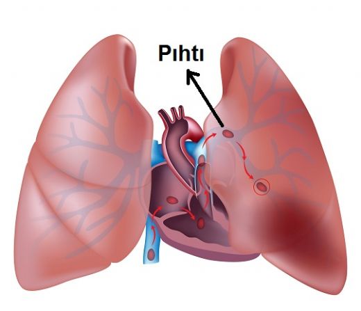 Akcierde Pht